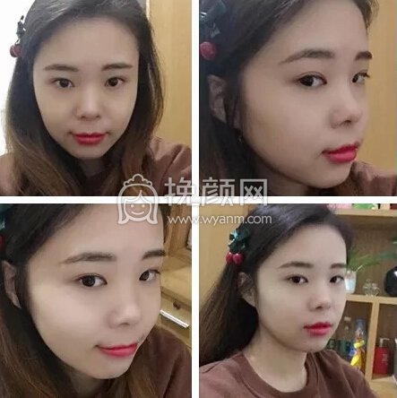 鼻子不好看会毁了整张脸,我就是活生生的例子