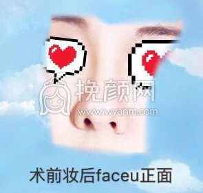 长沙新发现王先成硅胶鼻部手术