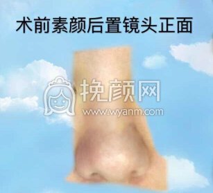 长沙新发现王先成硅胶鼻部手术