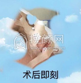 长沙新发现王先成硅胶鼻部手术