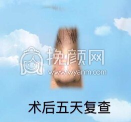 长沙新发现王先成硅胶鼻部手术