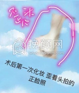 长沙新发现王先成硅胶鼻部手术