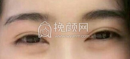 无锡丽都做的全切(睫毛根部)+提肌+开眼角