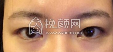 八大处尹宏宇双眼皮