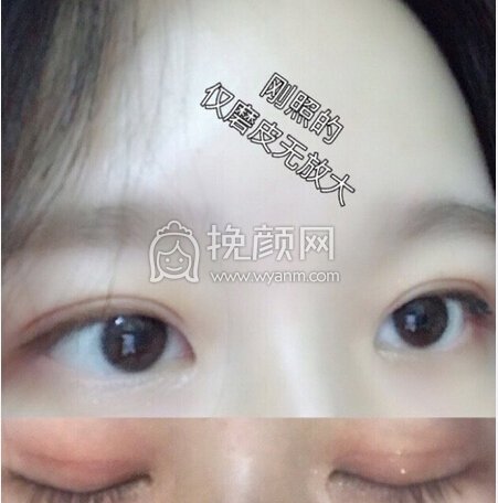 武汉天佑医院孔伟医生做的全切双眼皮