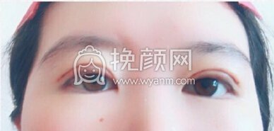 青医附院陈主任做的全切双眼皮去皮去脂