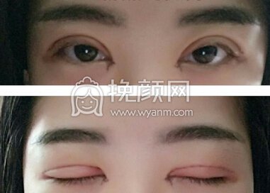武汉协和杨杰医生双眼皮修复+眼角+单侧提肌