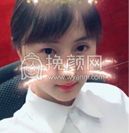 华美紫馨艾剑英做的全切双眼皮,填充上眼睑