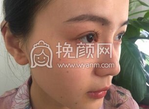 华美紫馨艾剑英做的全切双眼皮,填充上眼睑