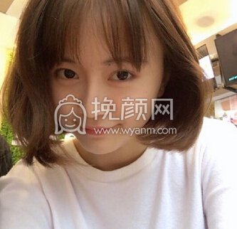 华美紫馨艾剑英做的全切双眼皮,填充上眼睑