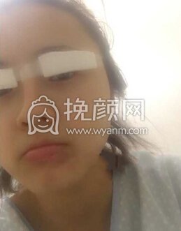 华美紫馨艾剑英做的全切双眼皮,填充上眼睑