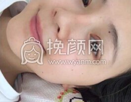 华美紫馨艾剑英做的全切双眼皮,填充上眼睑