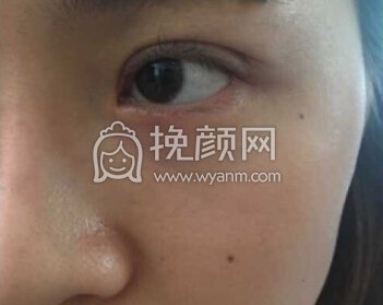 华美紫馨艾剑英做的全切双眼皮,填充上眼睑