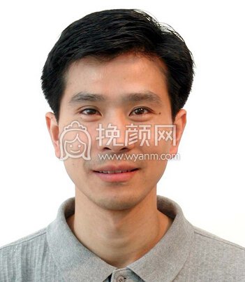 郑州悦美整形美容医院施越冬烧伤疤痕修复果