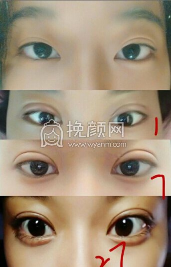 上海九院张波医生给做的双眼皮,去皮去脂
