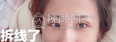莆田海峡整形医院做的全切