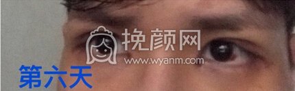 珠海科美杨医生全切开眼角提肌