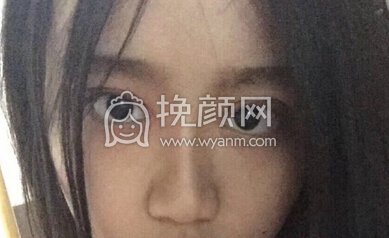 上海九院王业飞医生做的全切双眼皮开眼角
