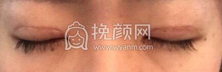 上海第九人民医院周慧芳医生做的全切去皮去脂