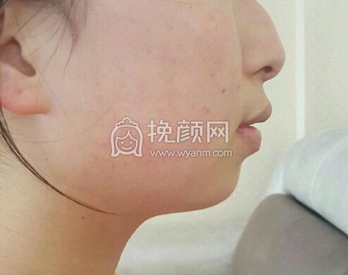 求小仙女们做下巴的经验分享 