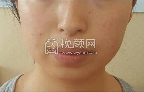 求小仙女们做下巴的经验分享 