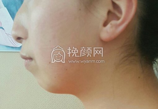 求小仙女们做下巴的经验分享 
