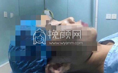 上海美仑整形鼻部手术,耳软骨垫鼻尖+硅胶鼻梁