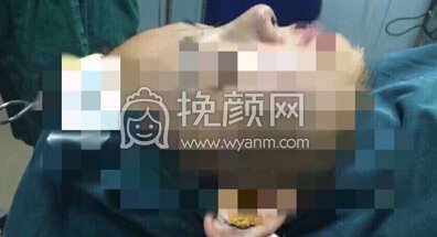 上海美仑整形鼻部手术,耳软骨垫鼻尖+硅胶鼻梁