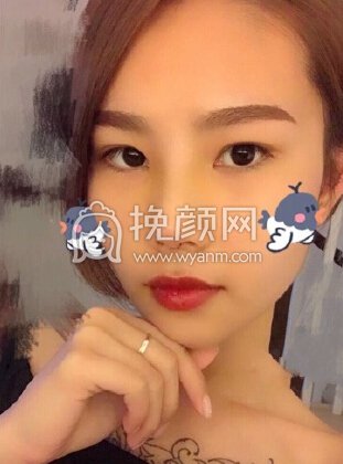 上海美仑整形鼻部手术,耳软骨垫鼻尖+硅胶鼻梁