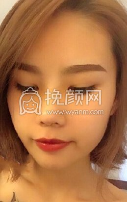 上海美仑整形鼻部手术,耳软骨垫鼻尖+硅胶鼻梁