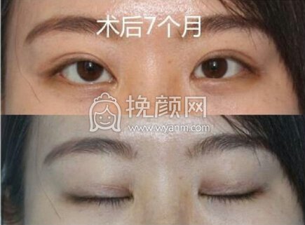 郑州孔宇医生做的上睑下垂修复