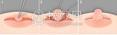 乳头内陷矫正术费用多少钱