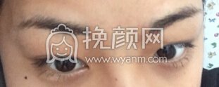 长沙申美医院俞医生做的切开双眼皮