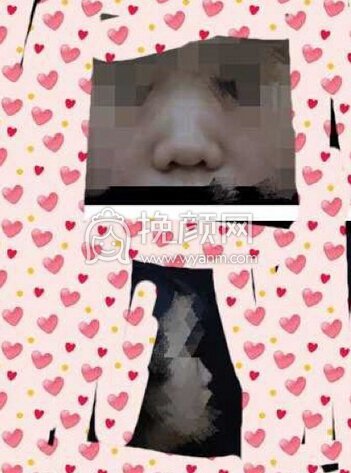重庆军美章主任做的鼻部手术