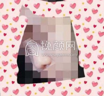 重庆军美章主任做的鼻部手术