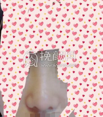 重庆军美章主任做的鼻部手术