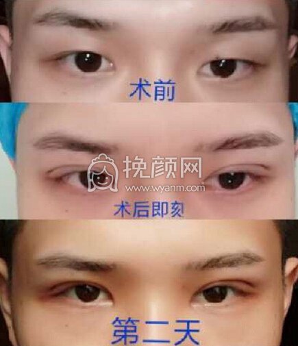 长沙星雅张光辉医生全切去皮去脂,外眦提升