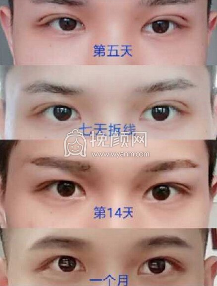 长沙星雅张光辉医生全切去皮去脂,外眦提升