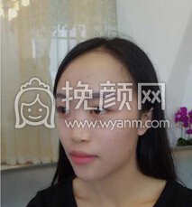 成都心悦容徐航鼻部手术、脂肪填充、厚唇变薄