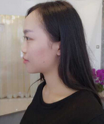 成都心悦容徐航鼻部手术、脂肪填充、厚唇变薄