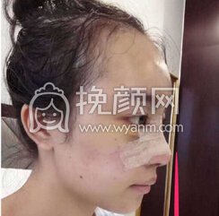 成都心悦容徐航鼻部手术、脂肪填充、厚唇变薄