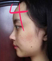 成都心悦容徐航鼻部手术、脂肪填充、厚唇变薄