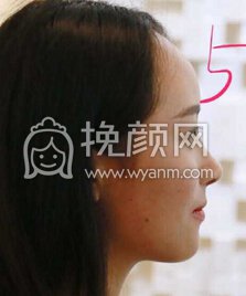 成都心悦容徐航鼻部手术、脂肪填充、厚唇变薄