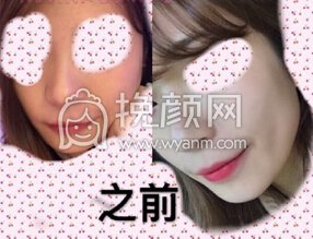 宁波珈禾整形医院隆鼻+丰下巴+注射瘦脸注射瘦脸