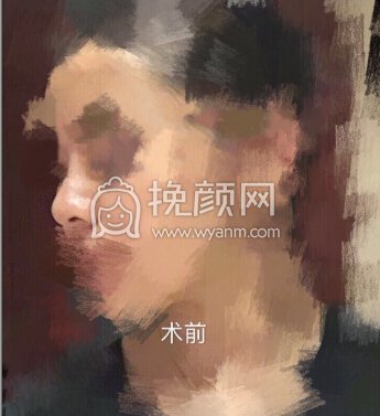 取了四年的鼻部膨体,做了硅胶+耳软骨垫鼻