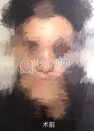 取了四年的鼻部膨体,做了硅胶+耳软骨垫鼻