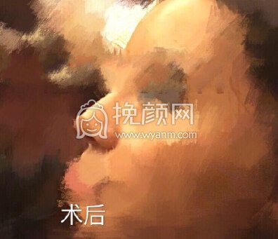 取了四年的鼻部膨体,做了硅胶+耳软骨垫鼻