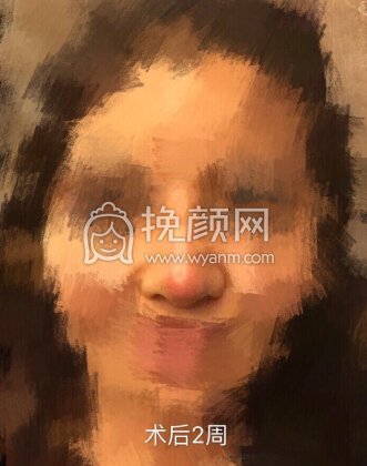 取了四年的鼻部膨体,做了硅胶+耳软骨垫鼻