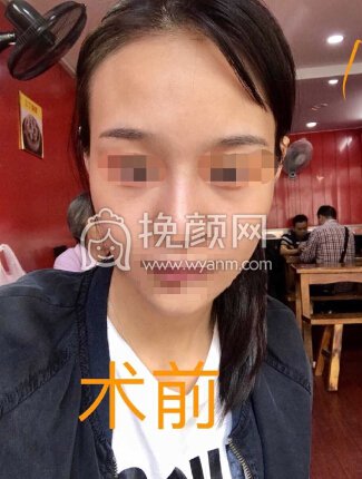 上海百达丽顾清鼻部手术加太阳穴