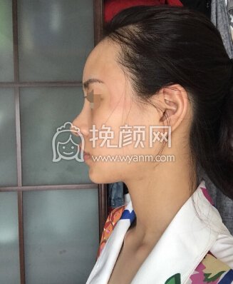 上海百达丽顾清鼻部手术加太阳穴